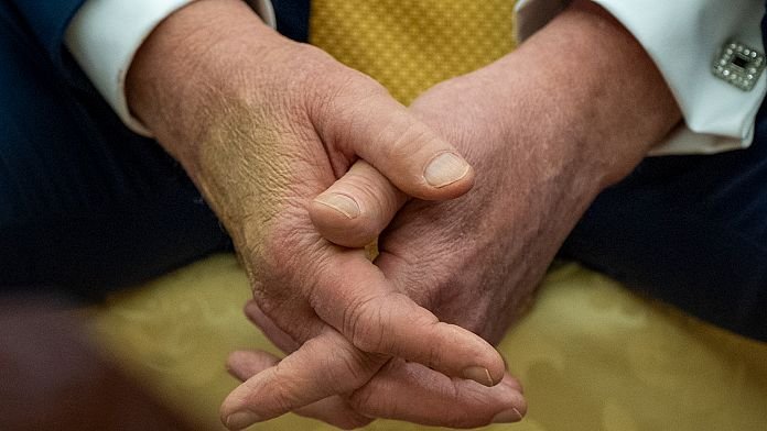 Trump es diagnosticado con insuficiencia venosa crónica tras una hinchazón en las piernas