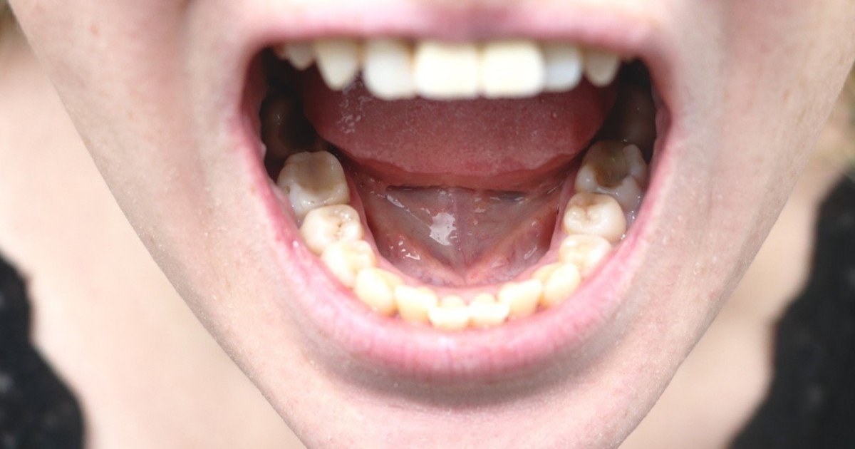 Cáncer de cabeza y cuello: preocupa la aparición más temprana vinculada al sexo oral