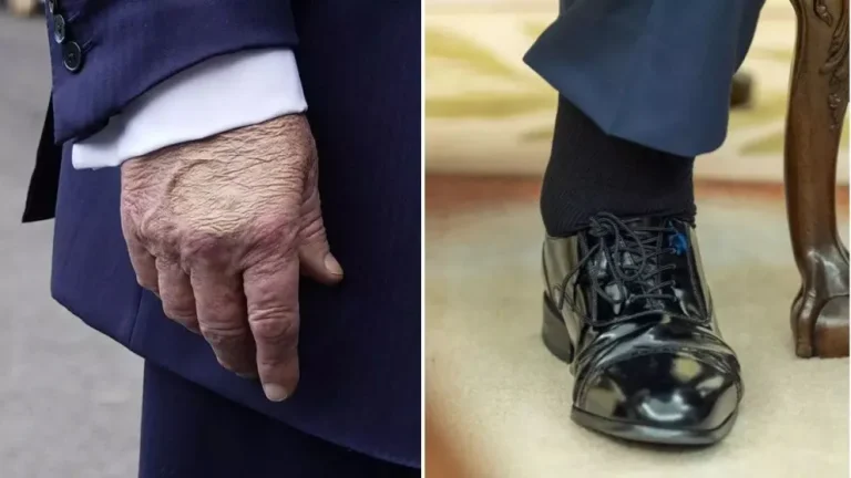 Preocupación por el estado de salud de Trump tras notar hinchazón en sus manos y piernas