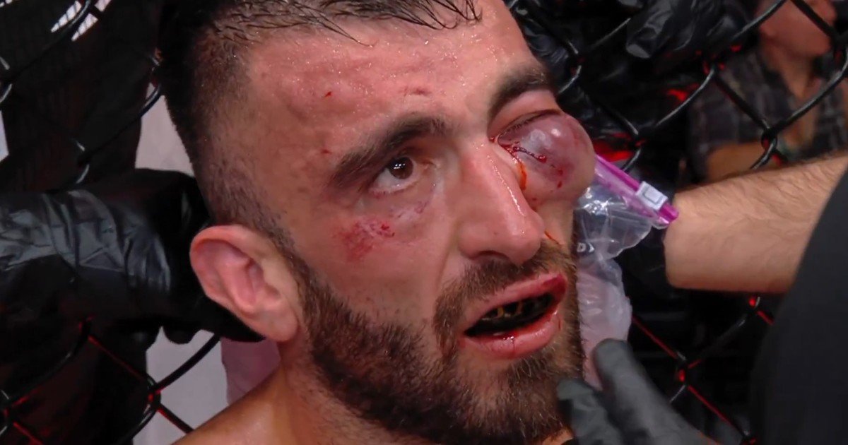 Escalofriante lesión en UFC Abu Dhabi: Mohammad Yahya quedó con un ojo a punto de explotar y pararon su pelea con Steven Nguyen