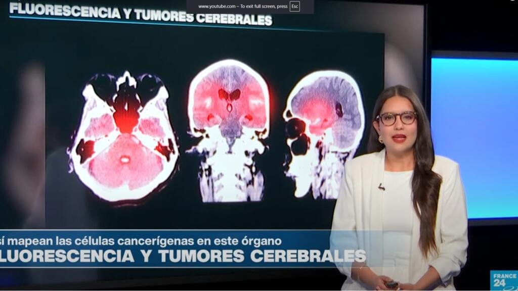 Fluorescencia y tumores cerebrales, así delimitan las células cancerígenas con 5-ALA