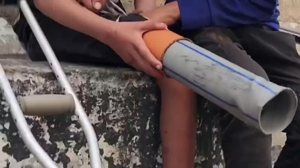 Guerra en Gaza: más de 4.000 palestinos han sufrido amputaciones