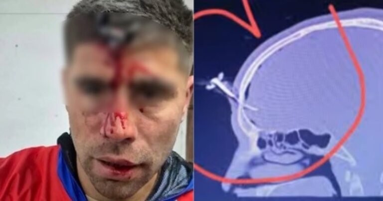 Le clavaron una llave en la cabeza a un jugador del Ascenso durante una salvaje pelea en un torneo de fútbol femenino