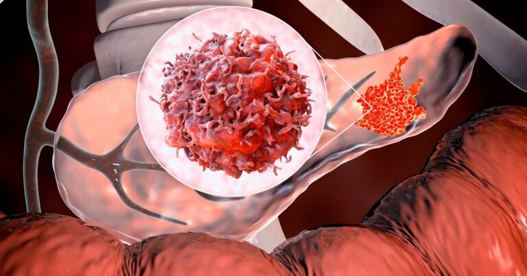 Cáncer de páncreas: de los desafíos a la esperanza