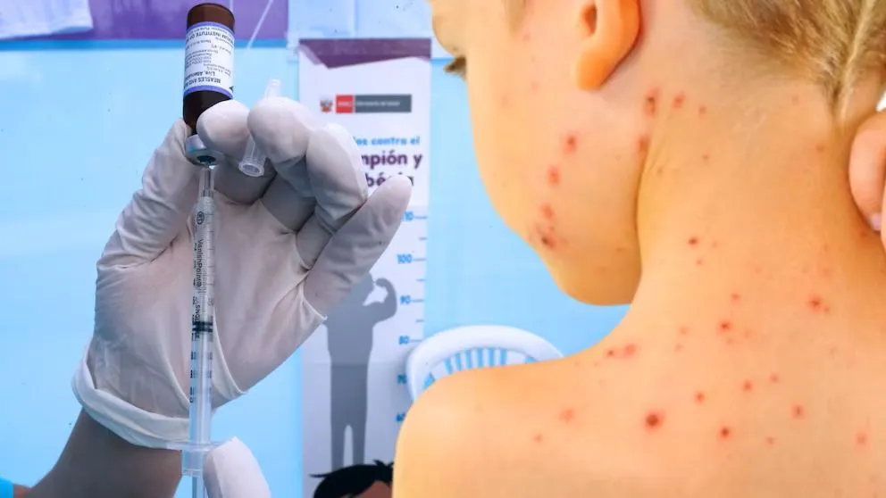 Adelantan la segunda dosis de la Triple Viral para reforzar la protección infantil