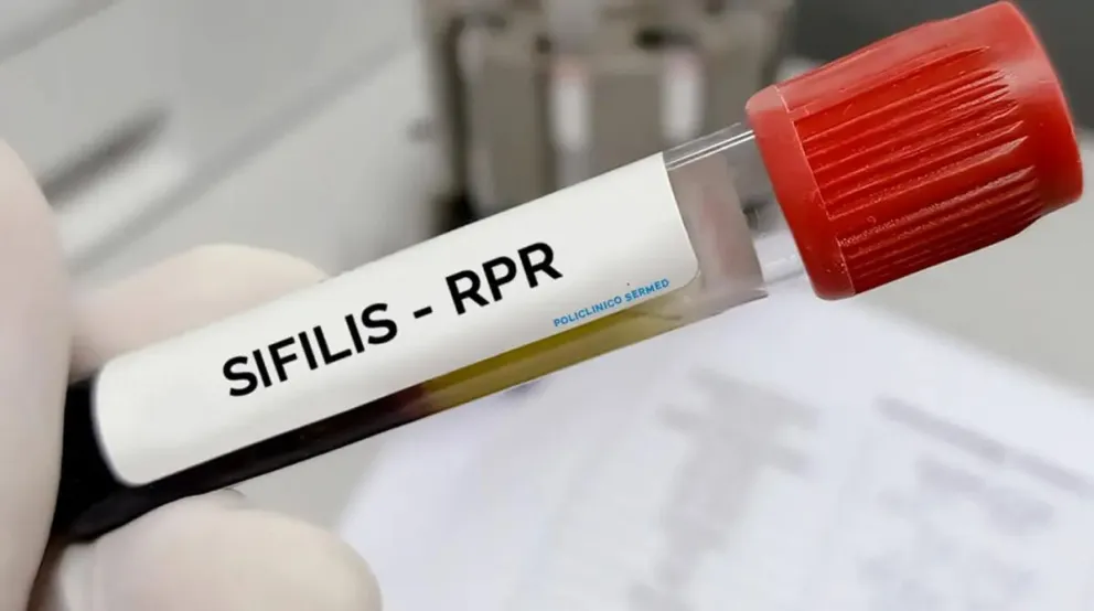 Récord histórico en Argentina: los casos de sífilis crecieron un 71 %