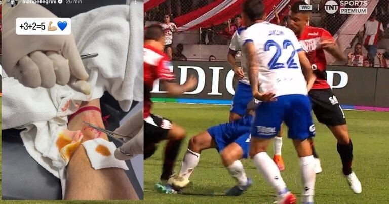 Matías Pellegrini mostró cómo quedó su pierna tras el planchazo que sufrió en el partido contra Instituto y bromeó con los puntos de sutura: "3+2=5"