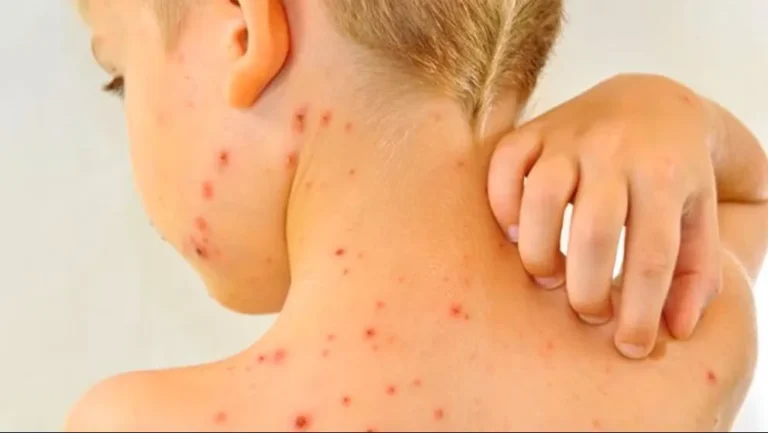 Vacunación infantil: Se adelantó la aplicación de dosis de la vacuna Triple Viral