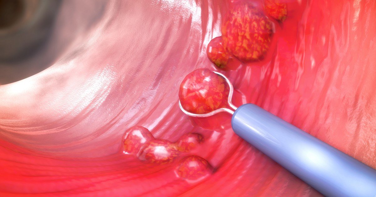 Cáncer de colon, ¿los 45 son los nuevos 50?: por qué aconsejan adelantar los controles