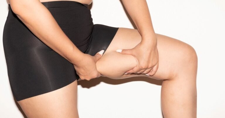 ¿Y si es lipedema? La enfermedad frecuente pero poco diagnosticada que suele confundirse con celulitis y obesidad