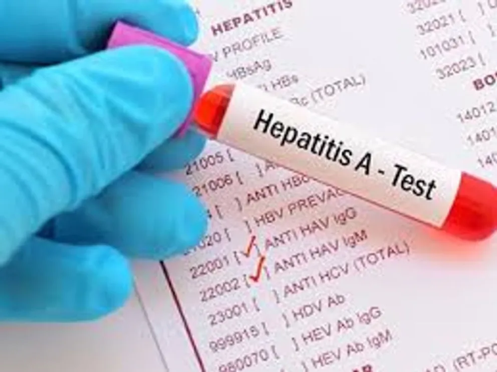 Argentina entra en zona de alerta por brote de Hepatitis A